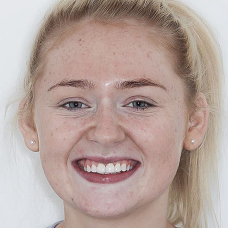 composite bonding-before - Carly - 3dental